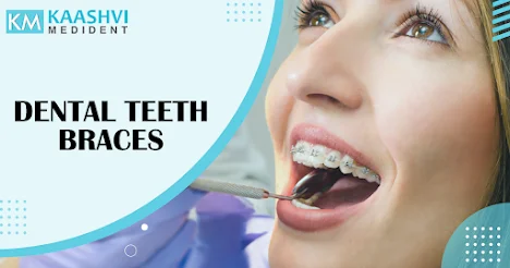 Dental teeth braces